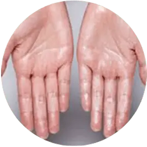 Hyperhidrosis Image