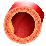 Peripheral Arterial Disease Image