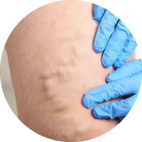 Varicose Veins Image