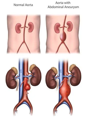 Aortic Aneurysm-2 Image