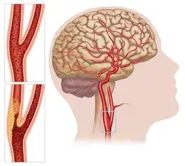Carotid-Artery-Disease