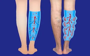 Deep Venous Thrombosis Image 2