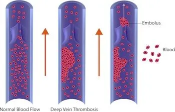 Deep Venous Thrombosis Image 1