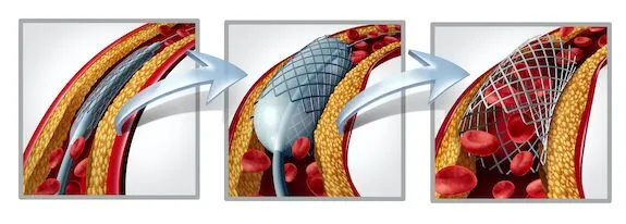 Angioplasty, Atherectomy, or stent placement Image1