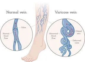 Varicose Veins-1