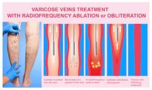 Endovenous Radiofrequency Ablation