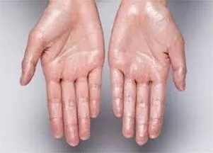 Hyperhidrosis Treatment-1