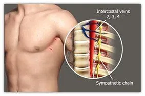 Hyperhidrdosis treatment-2