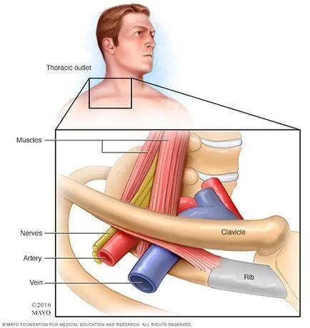 Thoracic Outlet Syndrome-3