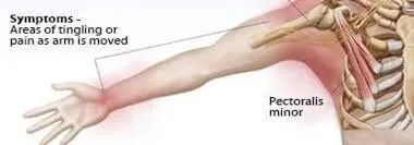 Thoracic outlet syndrome Symptoms: