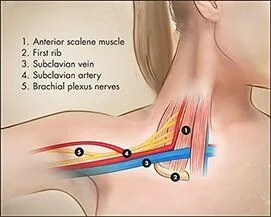 Thoracic Outlet Syndrome Treatment-3