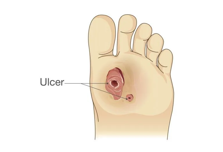 Ulceration: Image